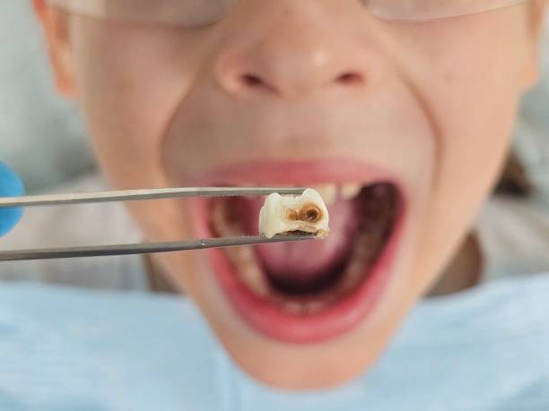 Best Cracked Tooth Emergency Dentist  in Baton Rouge, LA
